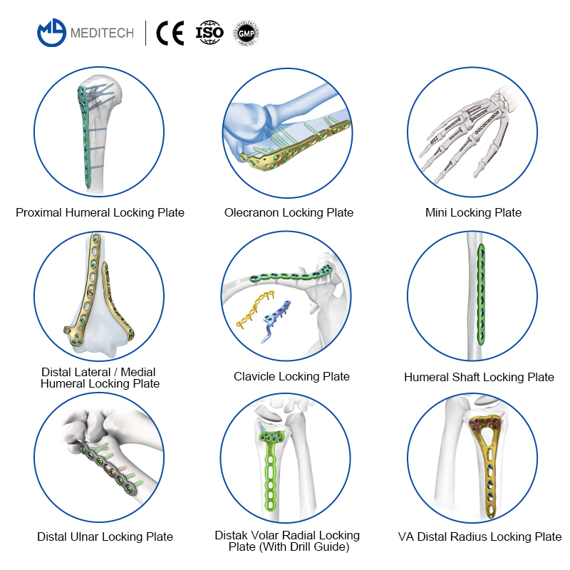Distal Medial Humeral Locking Plate