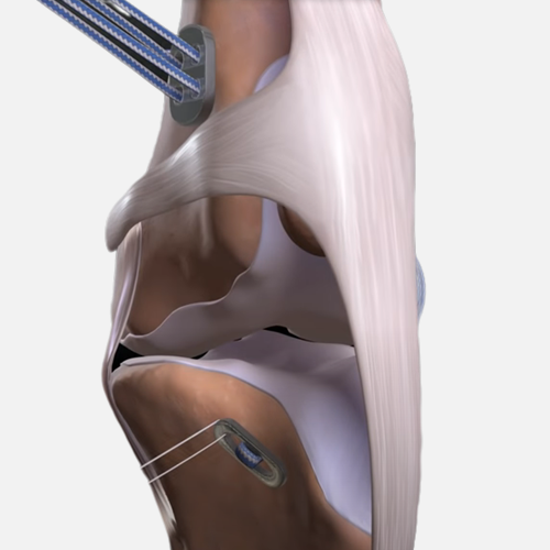 Sistem ligamen buatan
