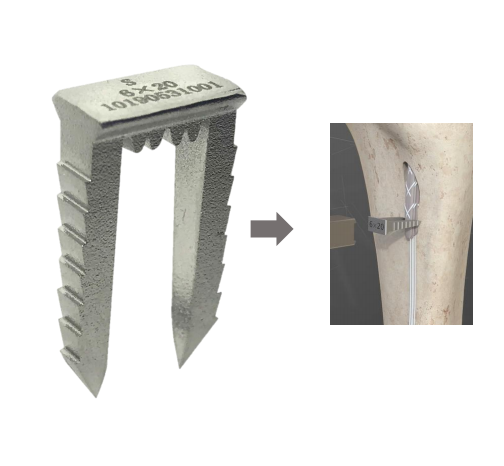 Staple ligamen