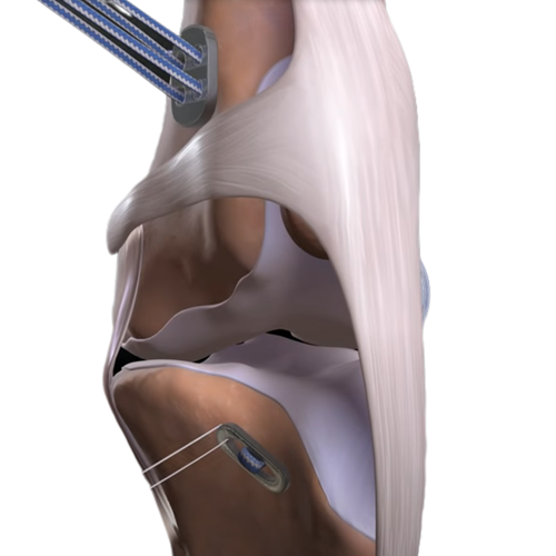 Sistem ligamen buatan