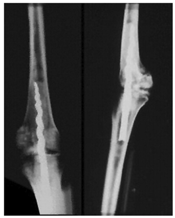 The ancient Egyptians first used an intramedullary device similar to a nail. Complex surgical fracture care was unlikely to have existed so many years ago. What is certain, however, is that the ancient Egyptians had great embalming techniques stemming from their belief in the resurrection of the body in the afterlife. This was the case with the mummy called Usermontu found in Tutankhamun's tomb, where a threaded nail was inserted between the femur and tibia to stabilize the knee joint (as in Figure 2). Archaeologists speculate that the mummy inside the sarcophagus was not Usermontu himself, but someone else who was replaced by ancient tomb robbers in 600 BCE. 2000 years later, Bernardino de Sahagun, an anthropologist on the Hernando Cortes expedition, reported the first use of intramedullary nailing in a living patient in Mexico. In 1524, he witnessed an Aztec bone surgeon (named "Tezalo") perform an osteotomy using an obsidian knife and then insert a resin rod into the medullary cavity to stabilize the fracture. Due to the lack of adequate surgical techniques and antiseptics, these procedures had a high complication rate and a high mortality rate.