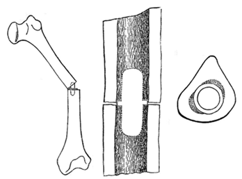 Intramedullary nail