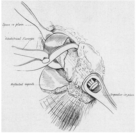 Intramedullary nail
