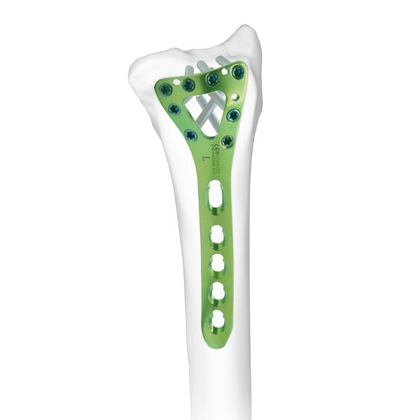 Pelat pengunci delta radial dorsal distal