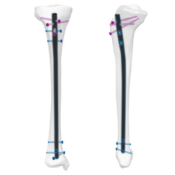 Paku Tibia Ahli