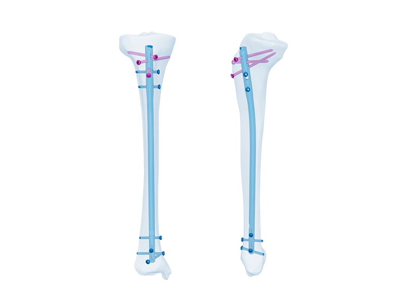 Expert Tibial Intramedullary Nail: Enhancing Orthopedic Surgeries